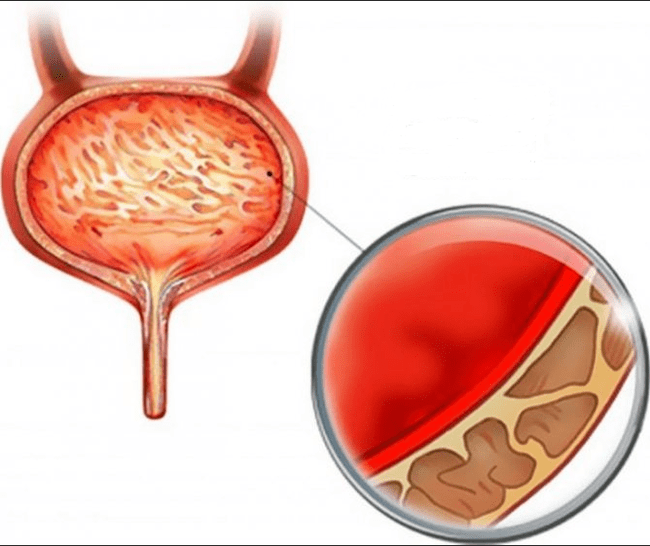 Inflammation of cystitis