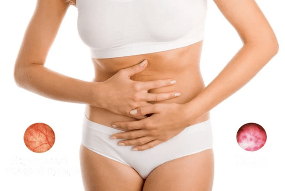 cystitis